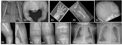 Neonatal Bone Disorders